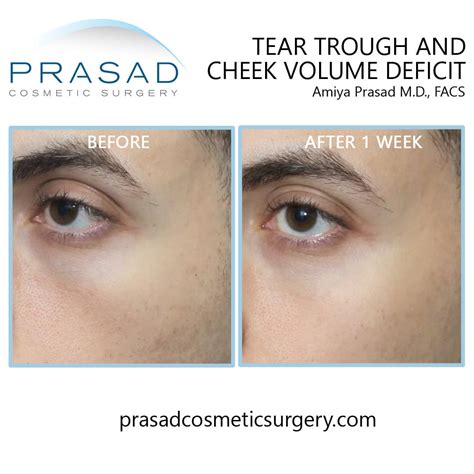 Under Eye Filler Before and After Photos - Prasad Cosmetic Surgery NY