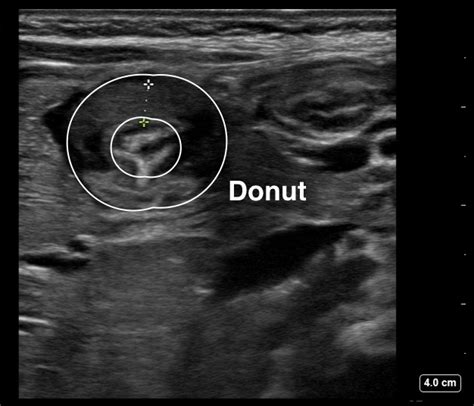 Pyloric Stenosis Upper Gi Series