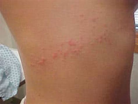 Sea Lice: That Nasty Rash You Get After Swimming In The Ocean