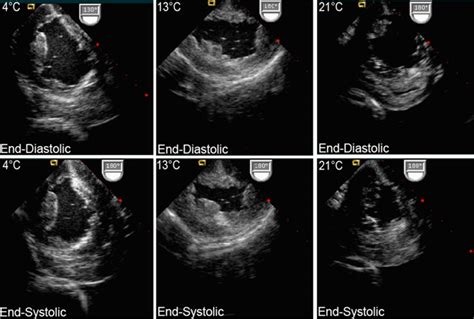 2D ECHO - Dr. Hitendra M. Bhagwatkar