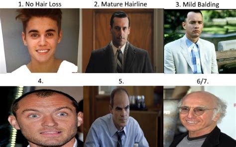 Norwood Scale - Asses Your Hair Loss With Pics & Celebrity Examples