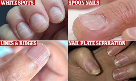 Experts reveal common nail problems and what these say about health ...