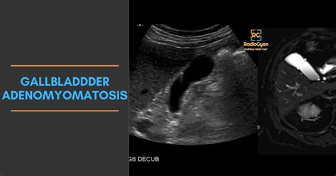 Gallbladder adenomyomatosis | Radiology Case - RadioGyan