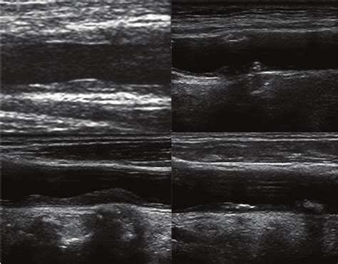 Variable tissue characterization of carotid plaque. (A) Single or focal... | Download Scientific ...