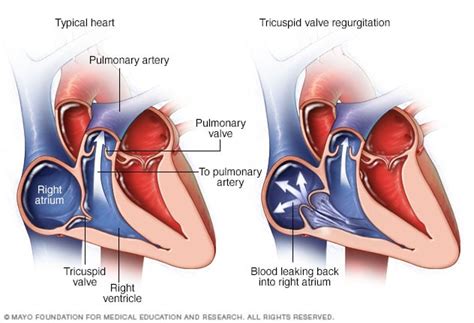 Tricuspid valve regurgitation - Mayo Clinic