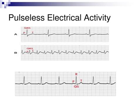 Ekg pulseless electrical activity - mineds