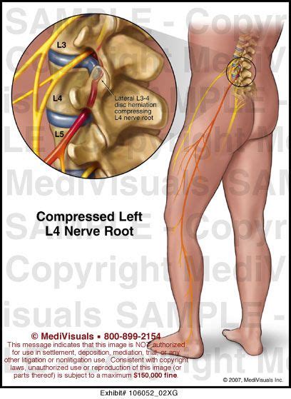 L3 L4 Nerve Root Pression | Shape fitness, Body map, Health