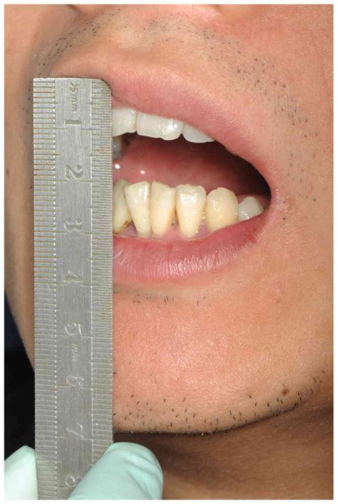 Persistent trismus following mandibular third molar extraction and its ...