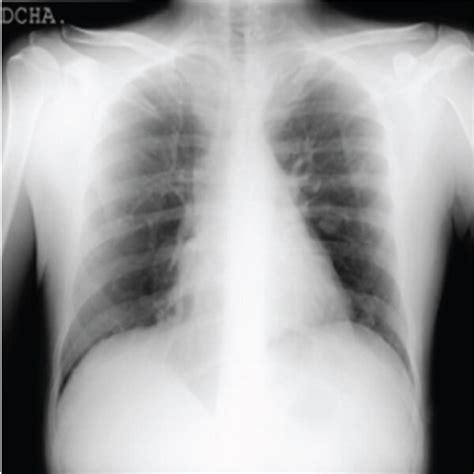 The sample X-ray images of (a) a viral pneumonia patient and (b) a ...