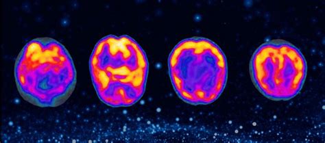 fMRI vs. SPECT Scan for the Brain | Cognitive FX