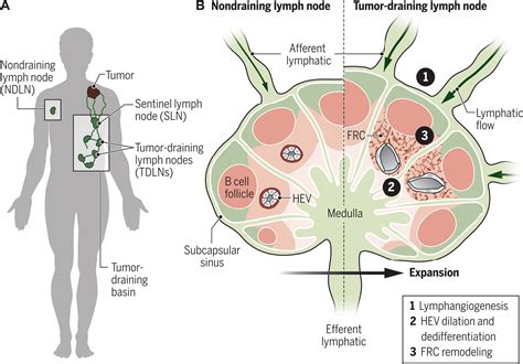 Lymph Node Metastasis In Cancer Progression: Molecular, 53% OFF