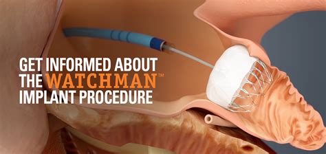 What Is A Watchman Device For AFib? — Dr. AFib™