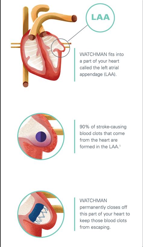 The Watchman Procedure