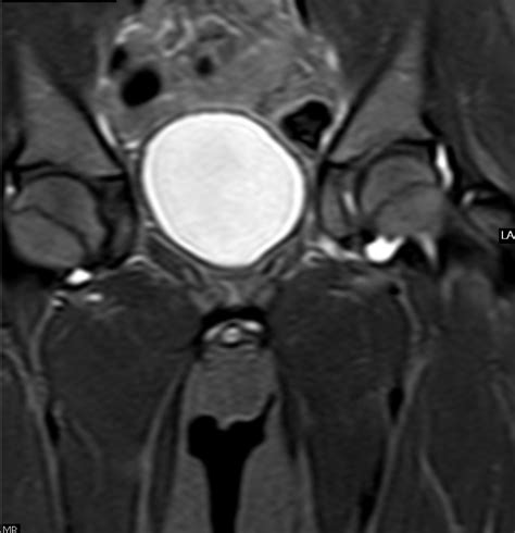 Transient Synovitis-Plain Film & MRI - Sumer's Radiology Blog