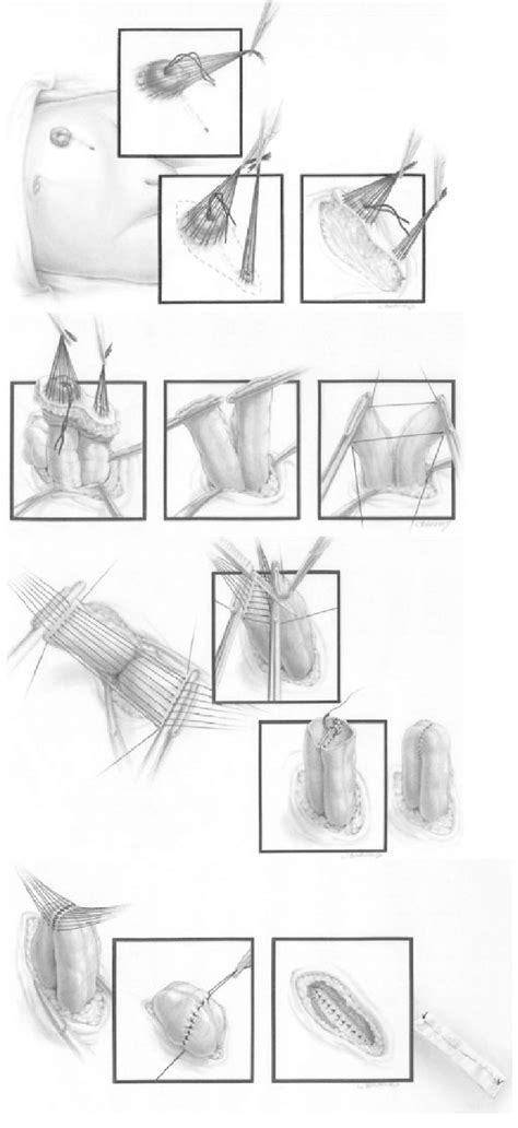 Artistic diagram of the colostomy closure technique | Download Scientific Diagram