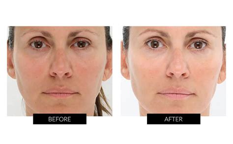 LightStim for Wrinkles | CurrentBody