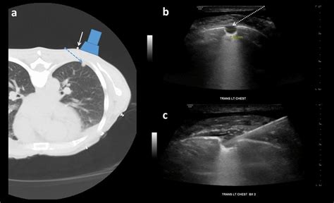 Real-time ultrasound guidance for pleural-based lung nodule biopsy of... | Download Scientific ...