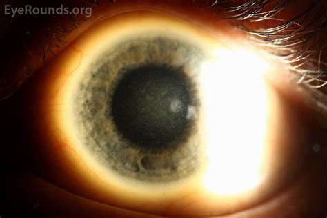 Avellino type II granular corneal dystrophy. EyeRounds.org Online ...