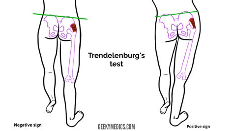 Hip Examination - OSCE Guide | Geeky Medics