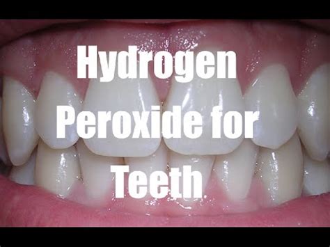 Hydrogen Peroxide for Teeth - Teeth Whitening Tips - YouTube