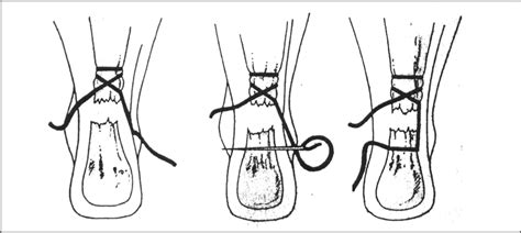 Achilles Tendon Tear Rupture Injury | Treatment & Recovery