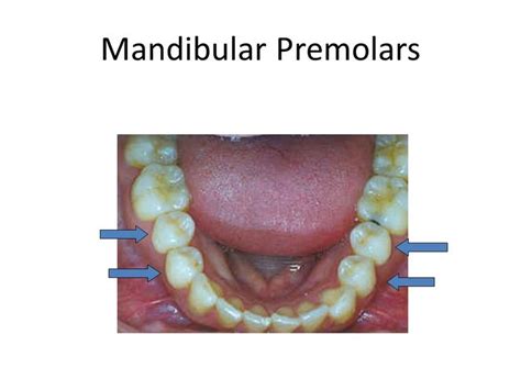 Image result for premolars | Dentistry, Image