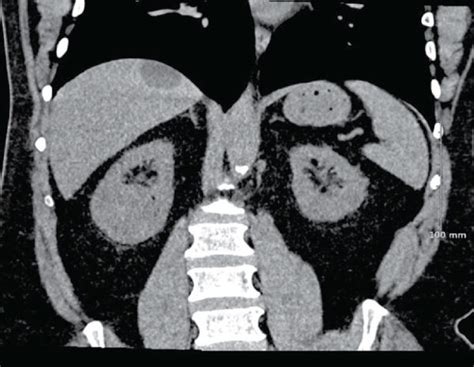 Ultrasound findings: transaxial (a) and long axis (b) views show the ...