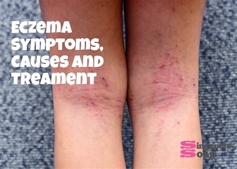 Eczema (Symptoms, Causes & Treatment) - Singapore Soap Supplies