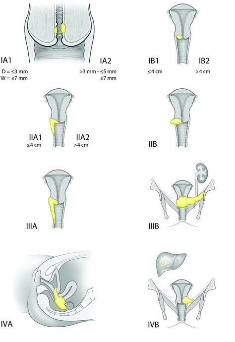 Stages of vulvar cancer | Vinmec