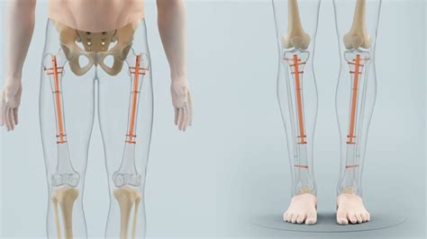 Limb Lengthening at Unimediks - Act Now Today!