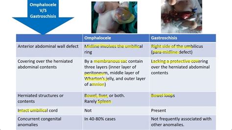 Omphalocele v/s Gastroschisis || Spot Diagnosis - 6 || Pediatrics - YouTube