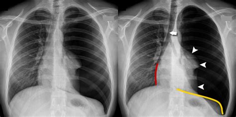 Tension Pneumothorax X Ray Findings