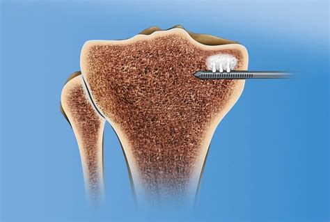 Subchondroplasty (SCP) in Singapore - Minimally Invasive Alternative To ...