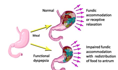 Lecture 10: UGI (Dysphagia, GERD, Dyspepsia) SGL Flashcards | Quizlet