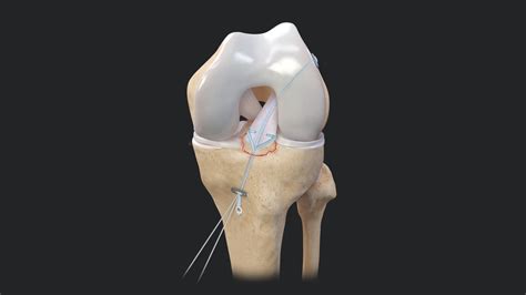 Arthrex - Tibial Spine Avulsion Repair Using the ACL Repair TightRope ...