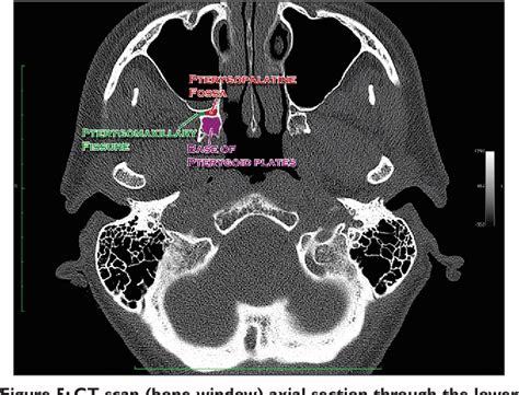 Figure 6 from Clinical functional anatomy of the pterygopalatine ...