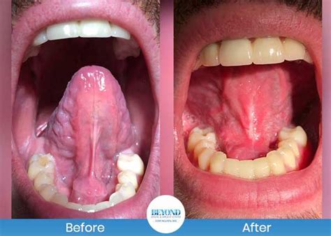 Tongue Tie Surgery Before & After Gallery in Dallas, TX