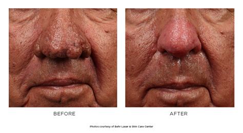 Rhinophyma Before & After Photos - Behr Laser & Skin Care Center