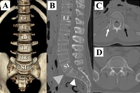 Figure 4 from The association between lumbar rib and lumbosacral transitional vertebrae ...