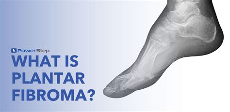 What is Plantar Fibroma? – PowerStep