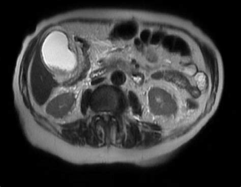Acute cholecystitis MRI - wikidoc