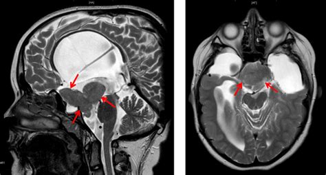 Pattern of a large hypothalamic hamartoma in an 11 years old female ...