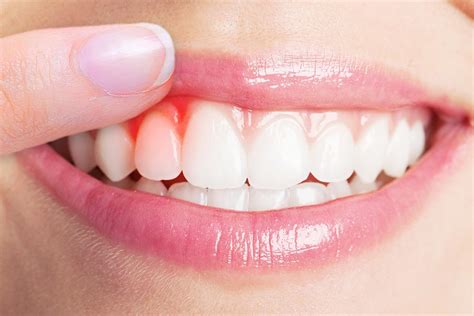 Gum Disease Treatment at Home | Elegantdentcare Blog