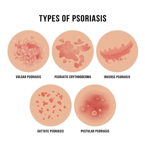 Psoriasis VA Disability Ratings and Benefits Explained | CCK Law