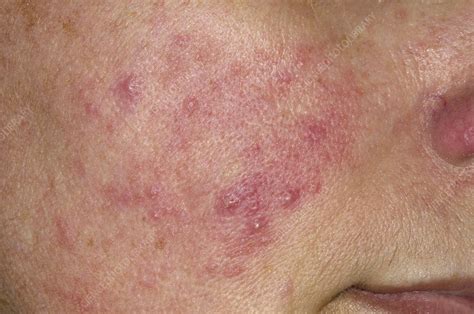 Acne rosacea on the cheek - Stock Image - C005/1852 - Science Photo Library