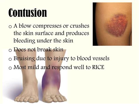 Contusion