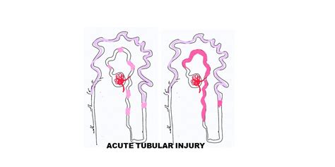 Pathology of Acute tubular injury/necrosis - Pathology Made Simple