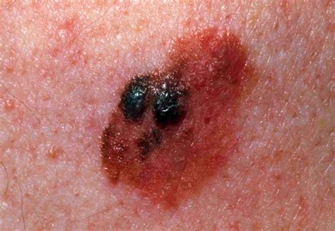 Spot the Differences Between a Mole and Skin Cancer