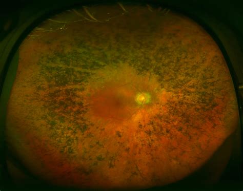 Retinitis pigmentosa - Miranza