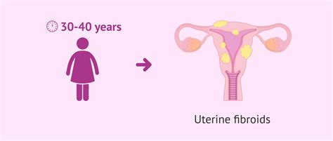 What is a myoma and when is it diagnosed?